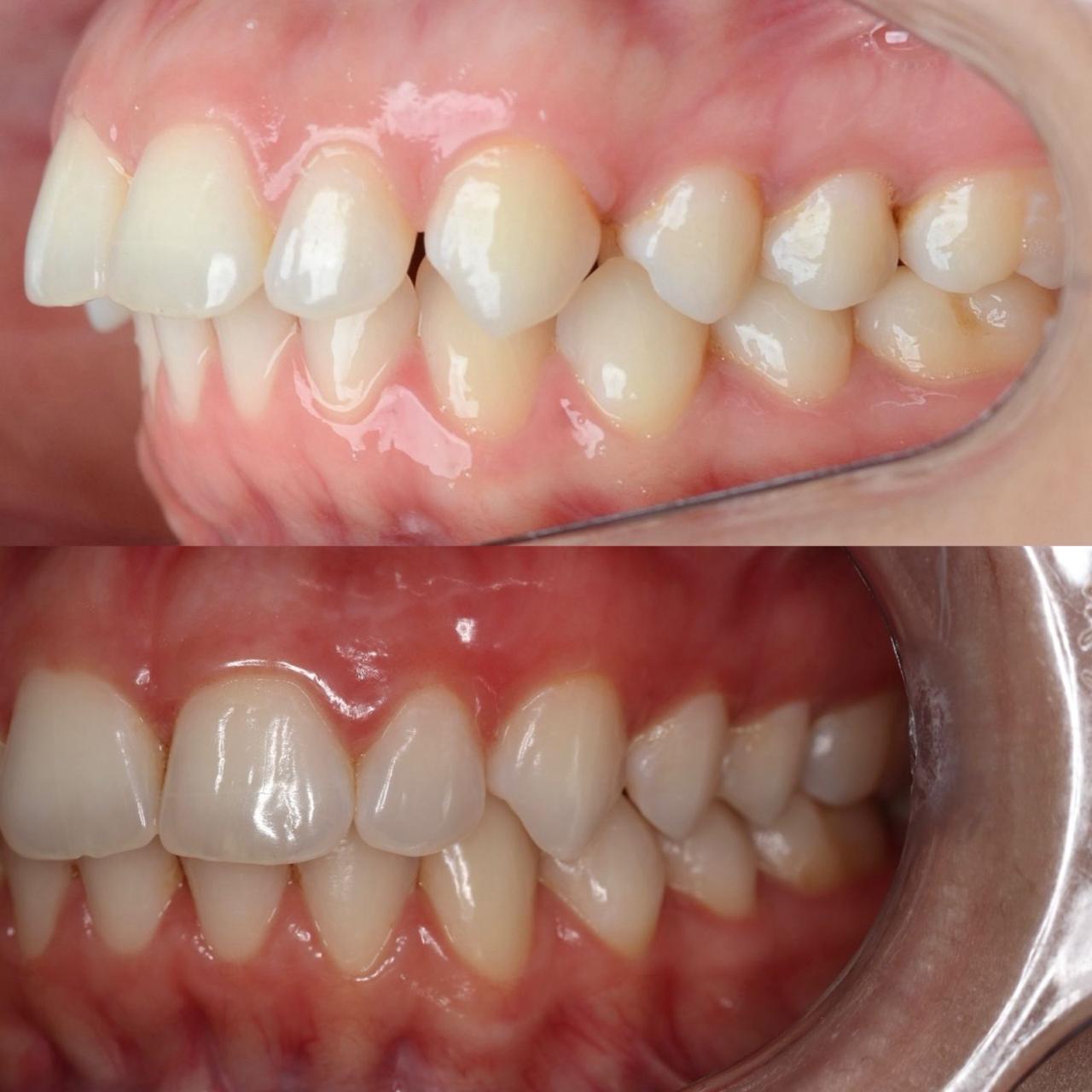 Caso 2 — Antes e depois: correção de mordida com Invisalign